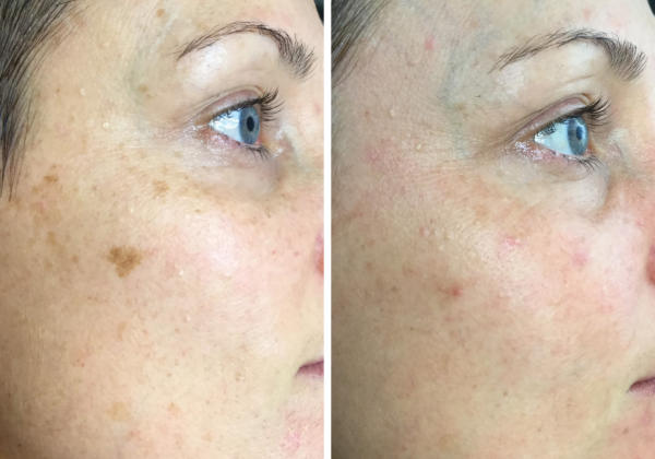 853258485mydmkbrandedbeforeandafterimagerydmkskinlrpigmentation6